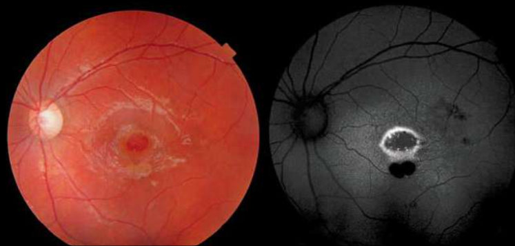 poškození oka laserem